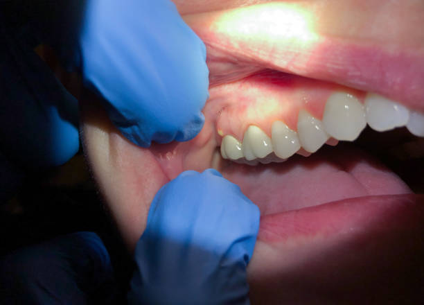 Best Emergency Broken Tooth Repair in Wellington, FL