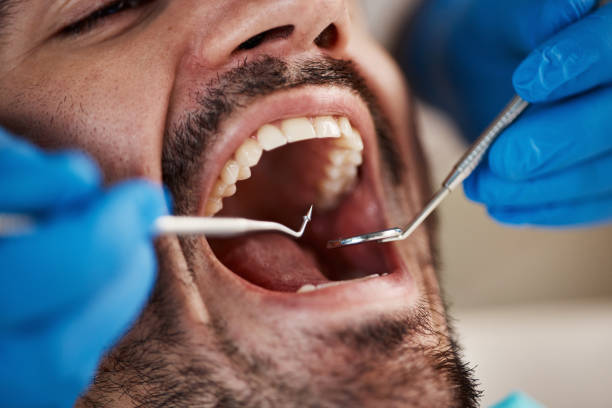 Best Emergency Tooth Extraction in Wellington, FL