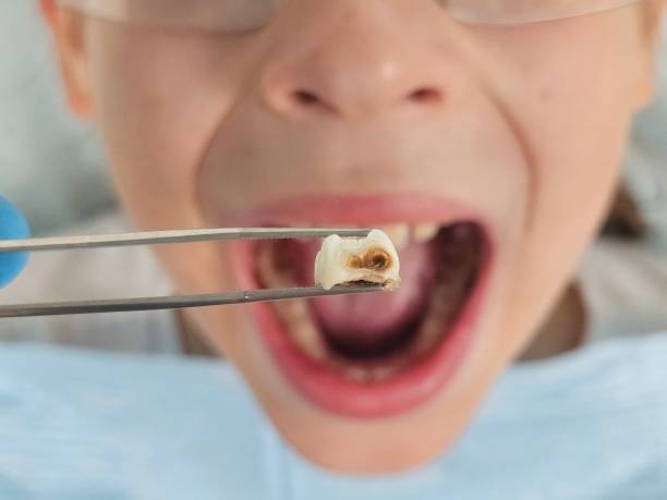 Best Emergency Root Canal Treatment in Wellington, FL